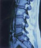 Spinal Stenosis...