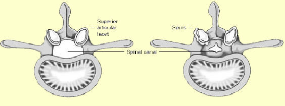 In spinal stenosis, the spinal canal, which contains and protects the spinal cord and nerve roots, narrows and pinches the spinal cord and nerves.