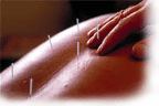 Acupuncture is a method of encouraging the body to promote natural healing and to improve functioning. This is done by inserting needles and applying heat or electrical stimulation at very precise acupuncture points.